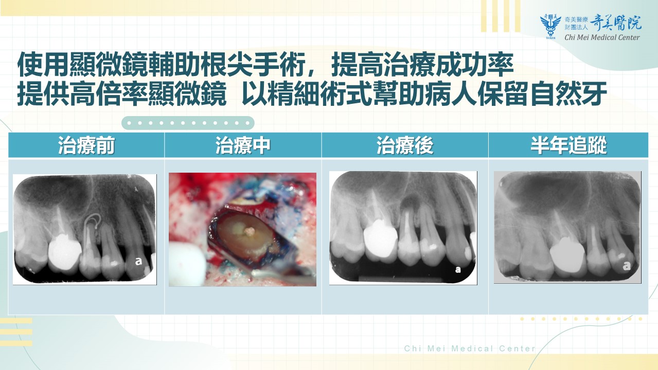 套了假牙還發炎！不密合假牙害婦人門牙藏「根尖囊腫」！奇美醫院採兩階段搶救